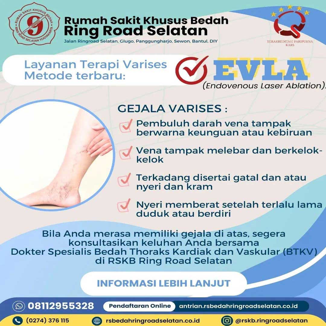 Pengobatan Varises Metode Laser